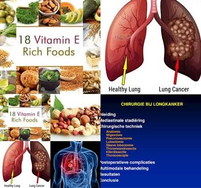 Longkanker en vitamine E.jpg