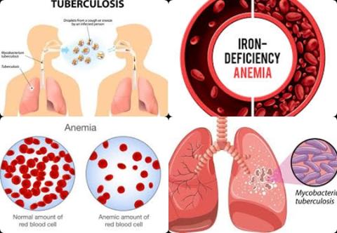 Anemia and tuberculosis.jpg