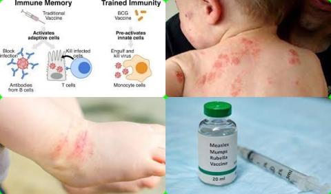 BCG vaccine and ezcema.jpg