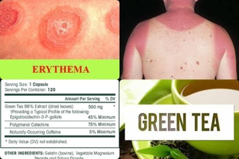 Green tea and sunburn.jpg