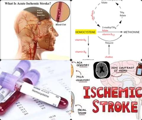 Homocystein and acute ischemic stroke.jpg
