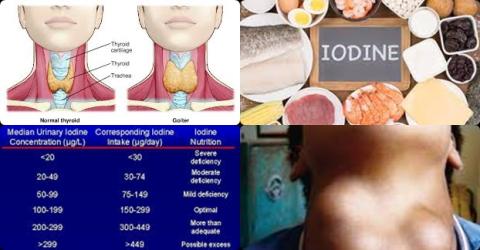 Iodine and goiter.jpg