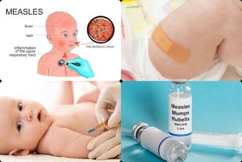 Measles and children.jpg