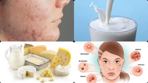 Melk en acne.jpg