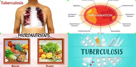 Micronutrient en tuberculosis.jpg