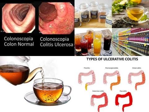 Thee en colitis ulcerosa.jpg