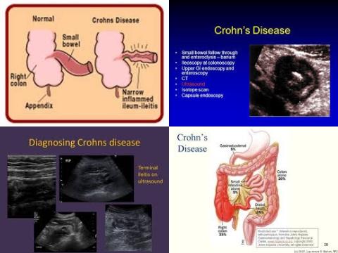 Ultrasound and Crohn disease.jpg