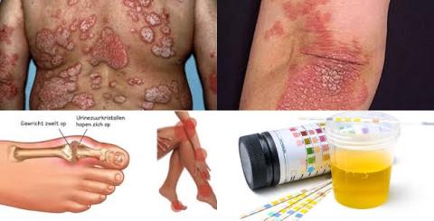 Urinezuur en psoriasis.jpg