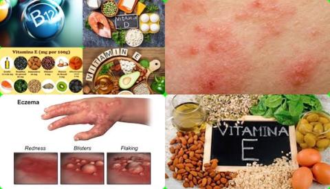 Vitamines en eczeem.jpg