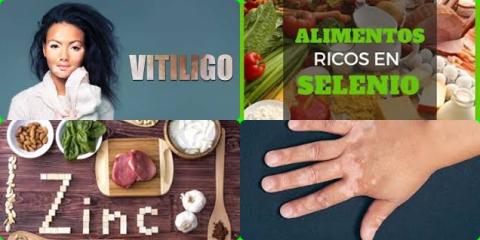 Vitiligo en zinc.jpg